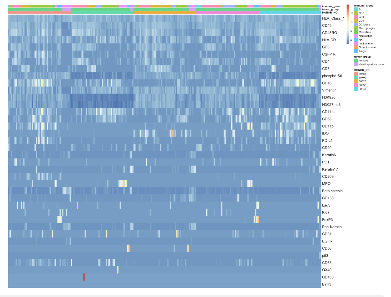 Heatmap of protein expression in tumor and immune cells in randomly selected five patients in MIBI-TOF data.